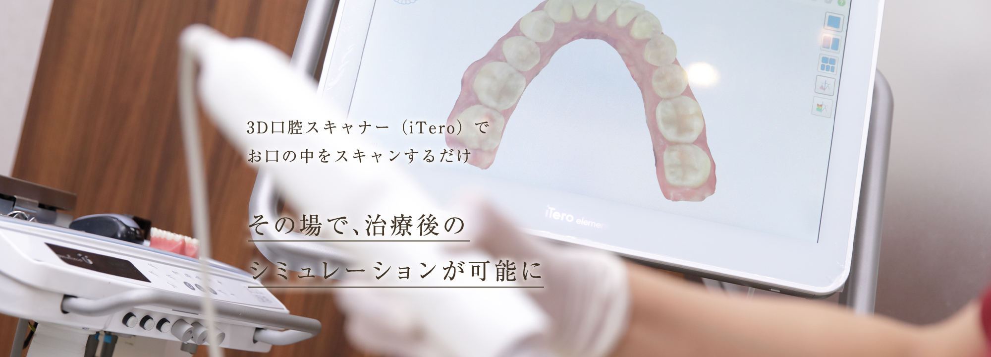 3D口腔スキャナー（iTero）でお口の中をスキャンするだけその場で、治療後のシミュレーションが可能に