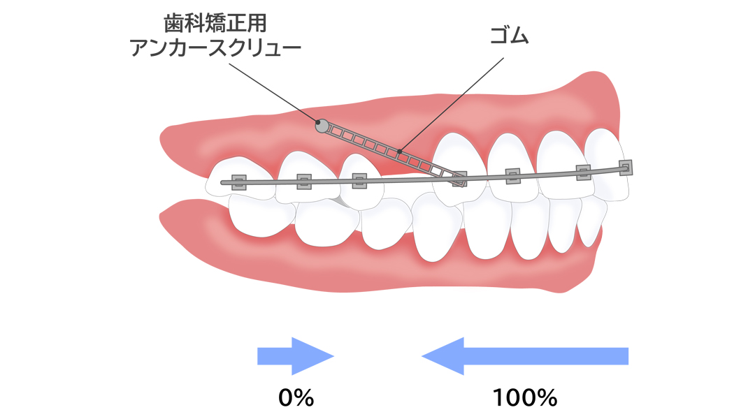 効率的に歯を動かせる 「インプラント矯正」にも対応可能です！