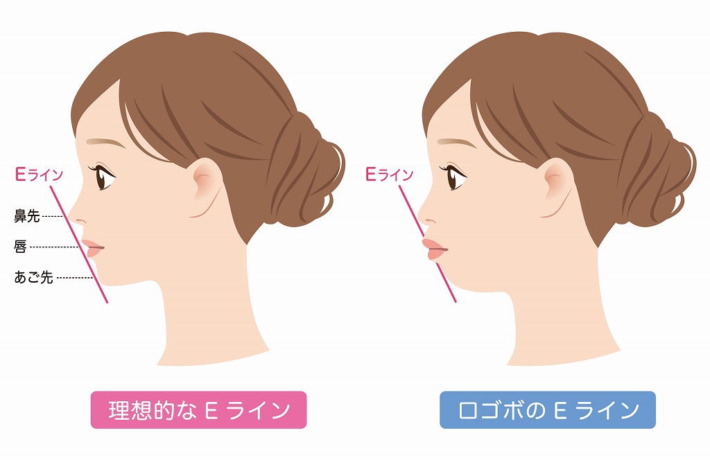 横顔のバランスが整い、自信につながる