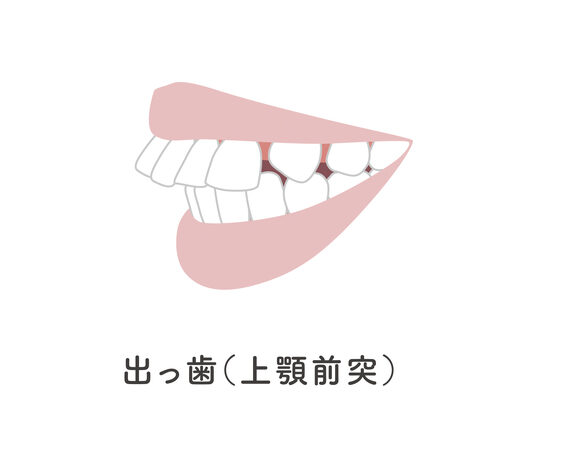 出っ歯