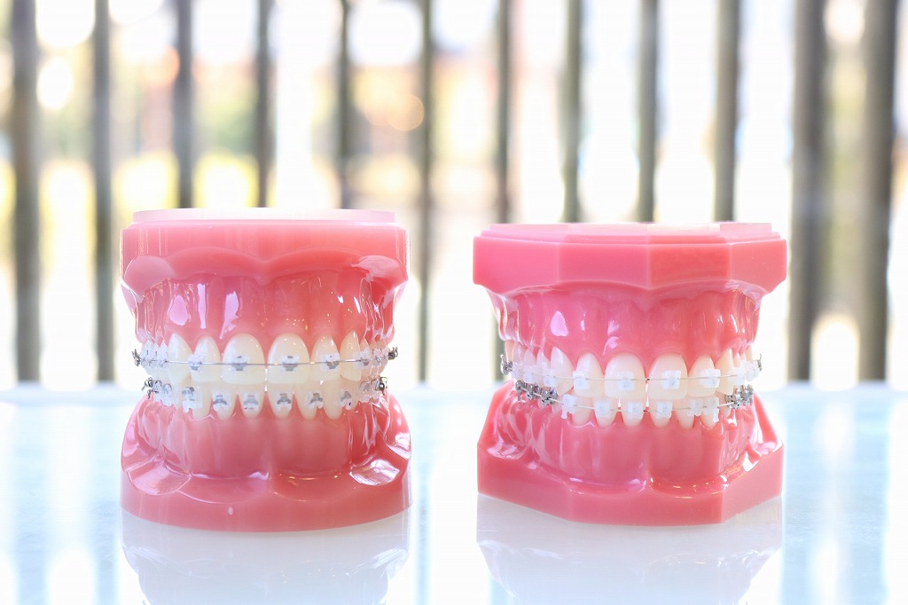 目立ちにくい表側矯正