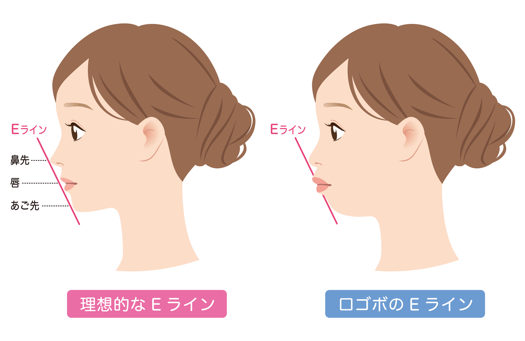 口元の突出が気になる(口ゴボ)お悩みありませんか？